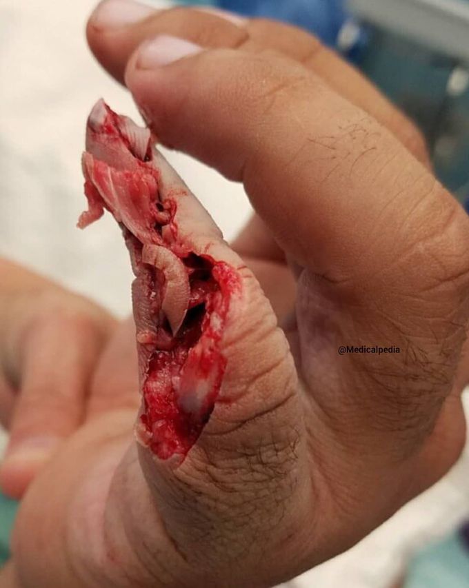 Buzz saw accident 