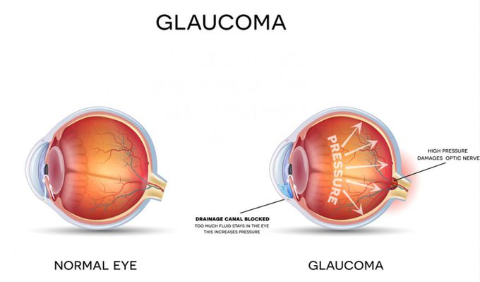Cause of Glaucoma