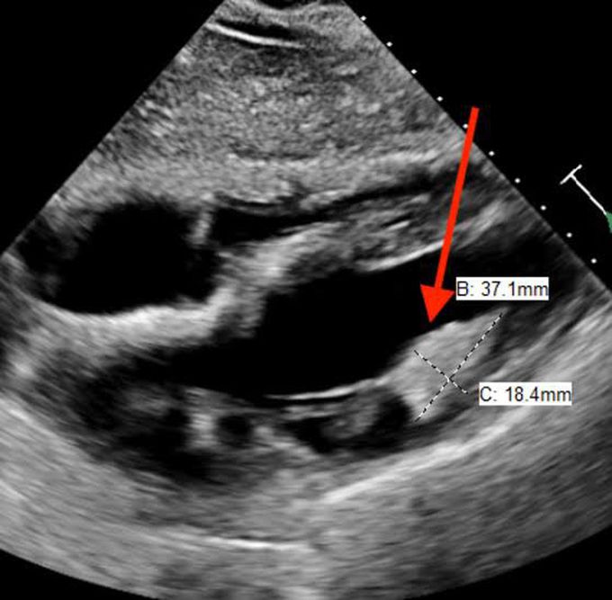 Rhabdomyoma