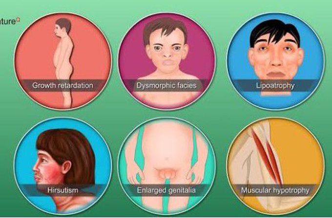 Symptoms of Donohue syndrome
