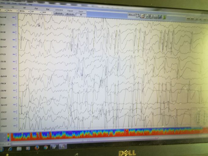 Epilepsy