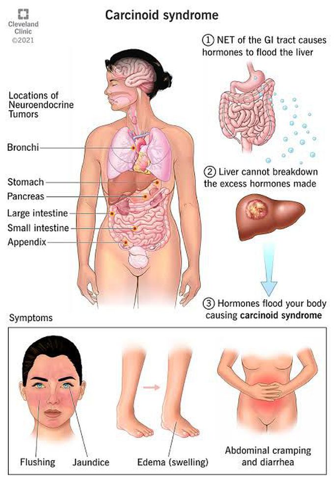 Carcinoid syndrome