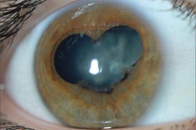 Cataract
