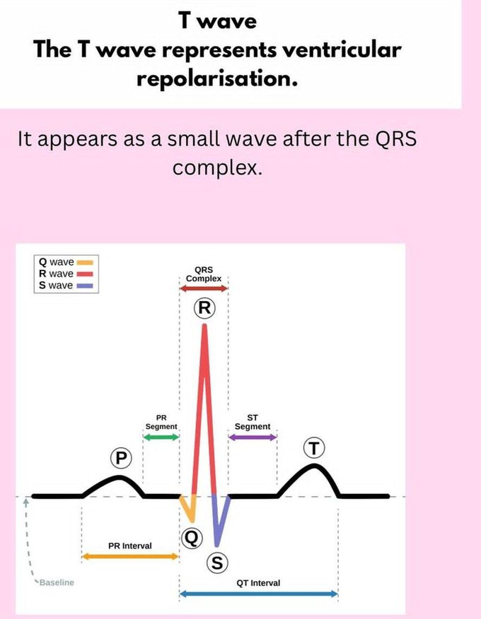 T Wave