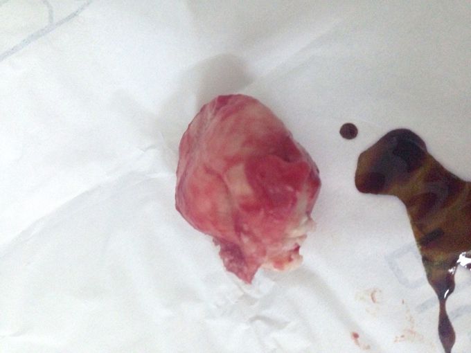 removal of fat gland from the knee part