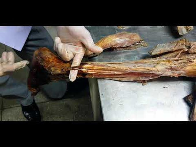 Dissection of the Lateral Compartment of the Leg.