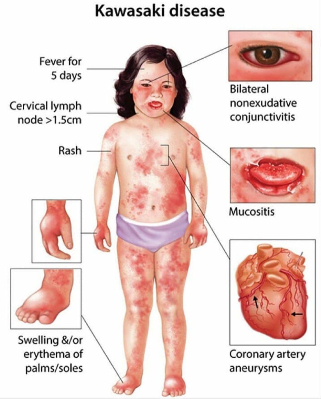Bulbar Conjunctivitis Kawasaki