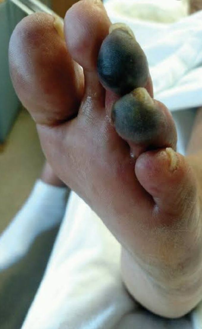 Blue Toe Syndrome