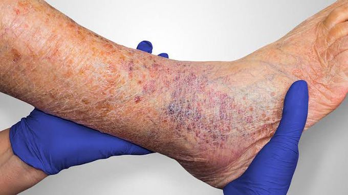 How is venous leg ulcer treated?