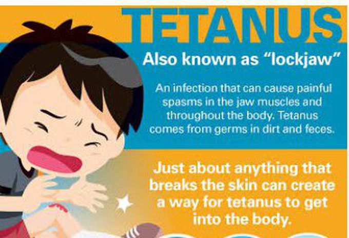 Tetanus also known as Lockjaw