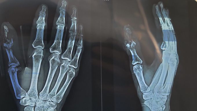 Traumatic Injury to Thumb