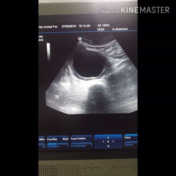 Abdominal Aortic Aneurism Rupture Abdominal Aortic Aneurism Rupture