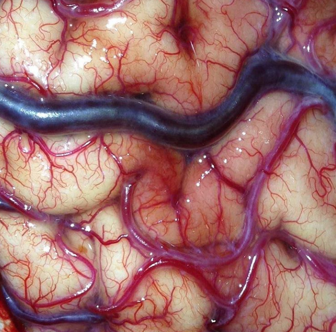 Brain Parenchyma