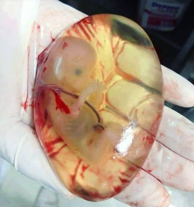 A case of miscarriage with the fetus still in its intact amniotic membrane.