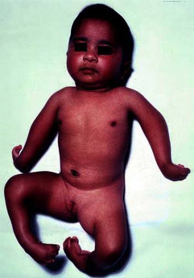 Arthrogyoposis Multiplex congenita