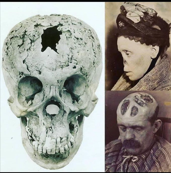 Can you name the disease in the picture ?