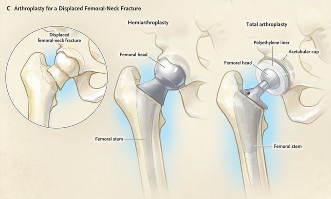 Arthroplasty