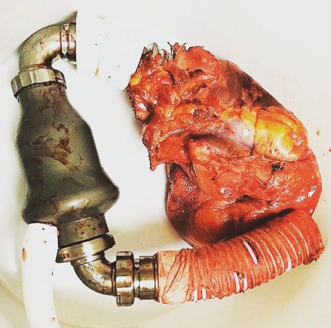 Ventricular Assist Device ☝🏻️