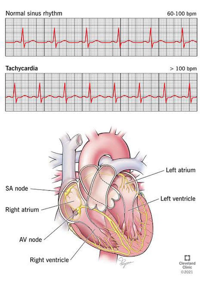 Tachycardia