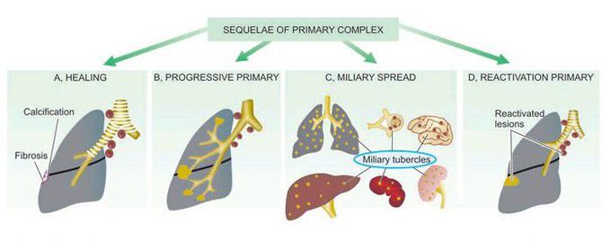 Primary complex tuberculosis