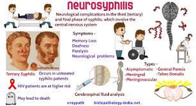 Causes of neurosyphilis