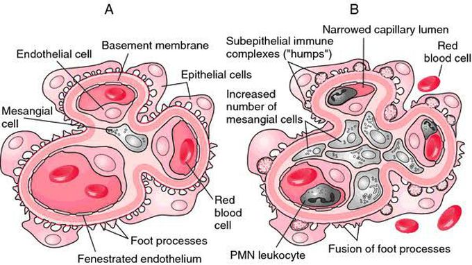 Crescentic Glomerulonephritis