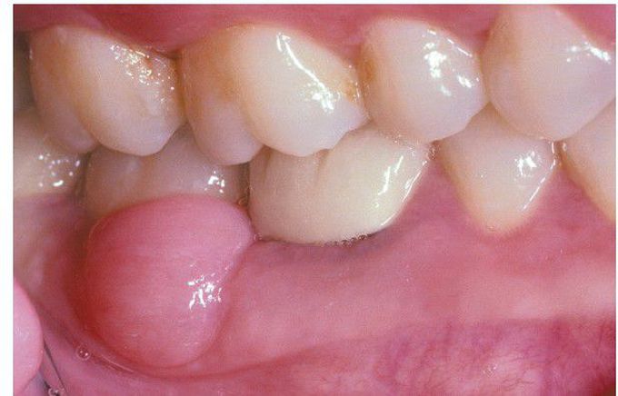 Oral Focal Mucinosis