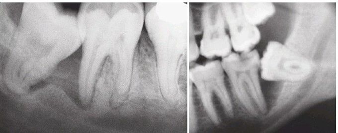 Impacted 3rd molars