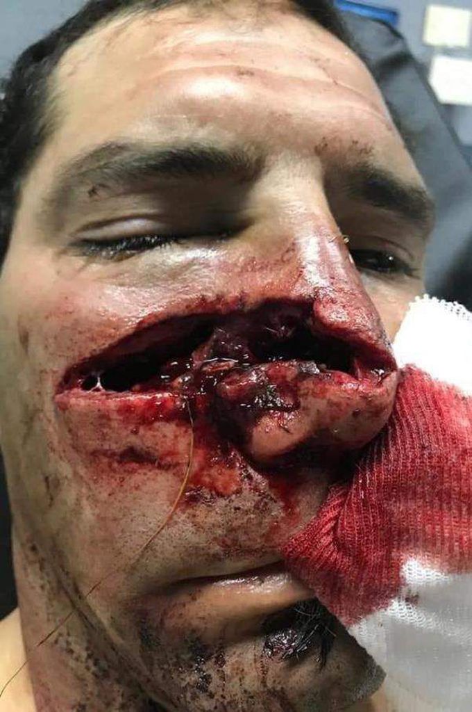 Animal bite.