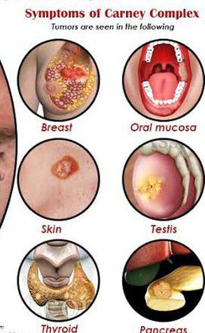 These are the symptoms of Carney syndrome