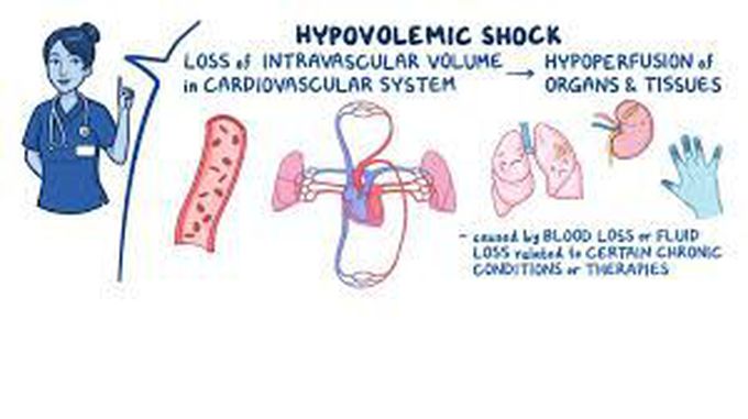 Treatment for hypovolemic shock