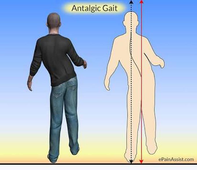 Antalgic gait