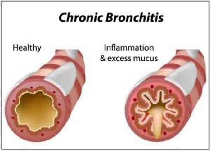 Chronic bronchitis