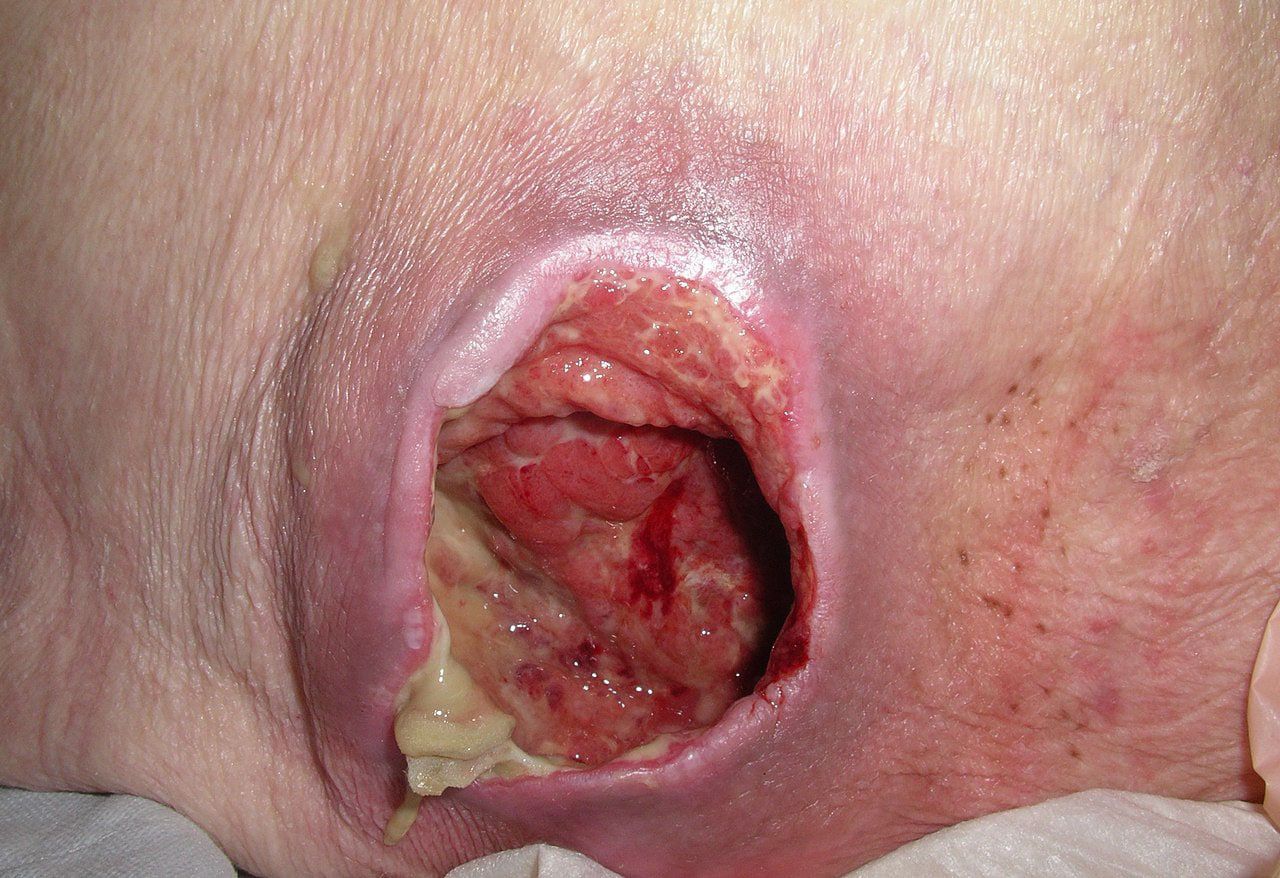 Pressure Ulcers Aka Decubitus Ulcers My XXX Hot Girl