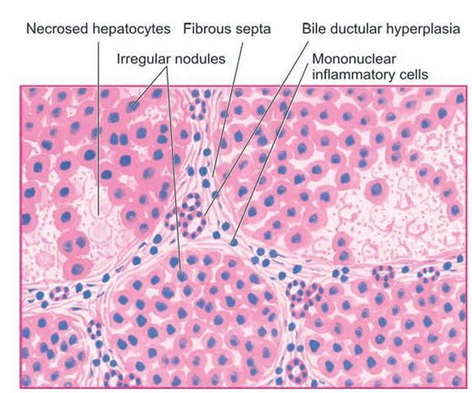 Post-necrotic cirrhosis.