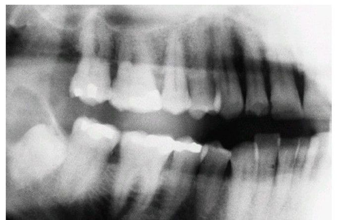 Dentigerous cyst