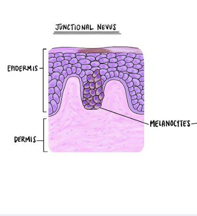 Junctional nevus