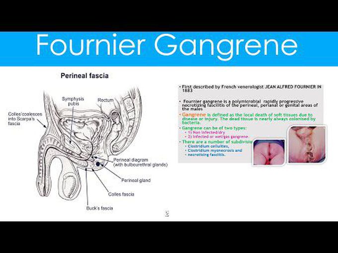 Fournier's Gangrene