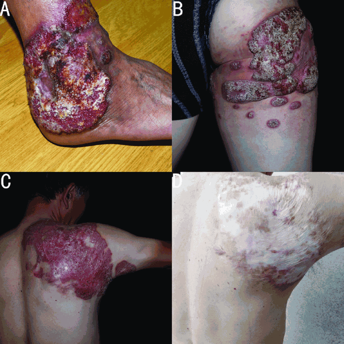 What is verrucous skin lesion?