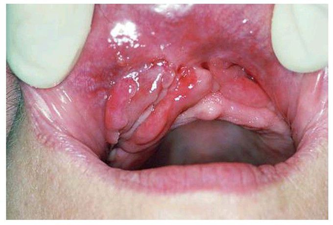 Fibrous hyperplasia