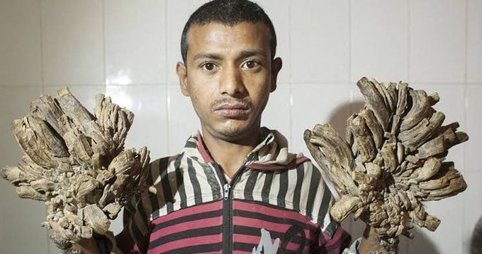 Abul Bajandar the Tree-man