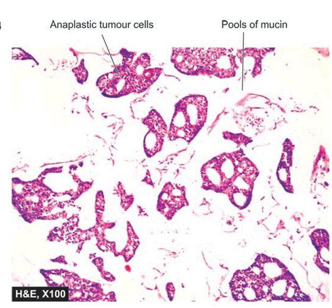 Colloid (mucinous) carcinoma breast.