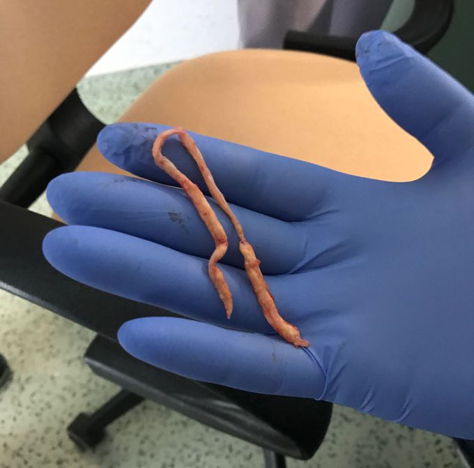 Atherosclerotic Plaque