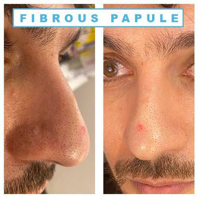 Fibrous papule treatment