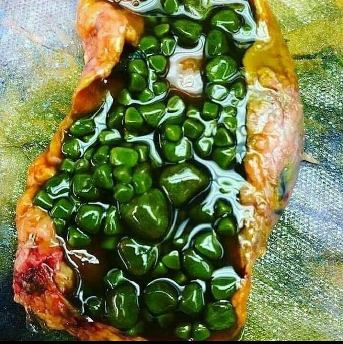 Gallstones