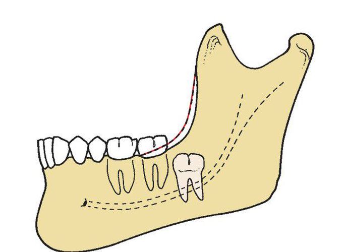 Bony impaction