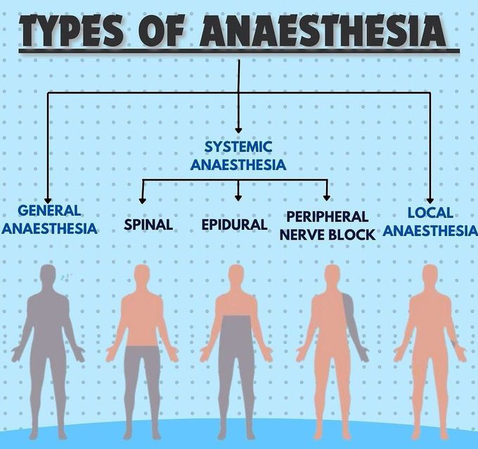 Types of Anesthesia