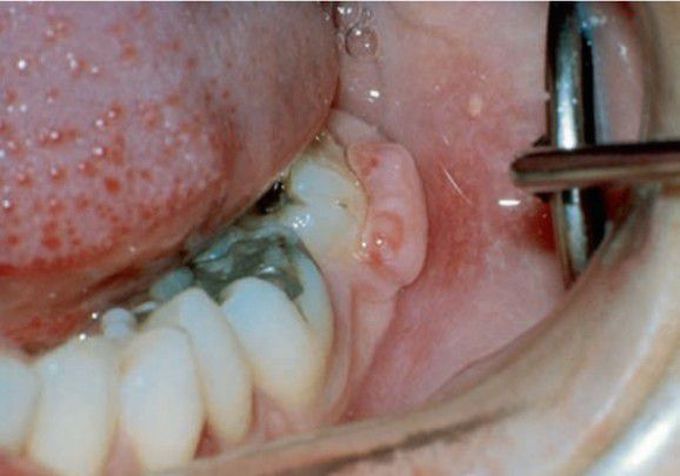 Peripheral fibroma