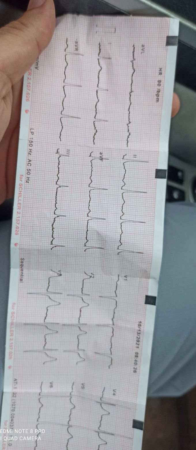 Ecg findings