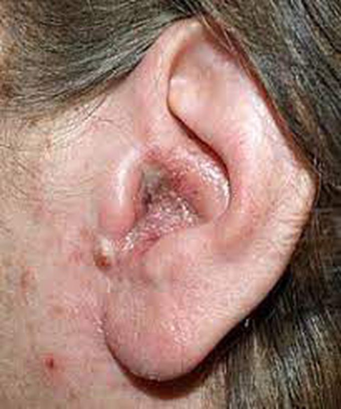 Symptomsof otitis externa